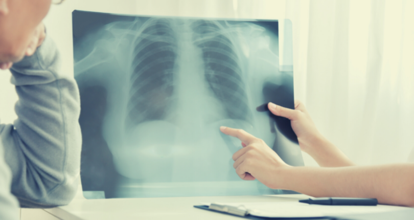 Qué es la Enfermedad Pulmonar Obstructiva Crónica o EPOC